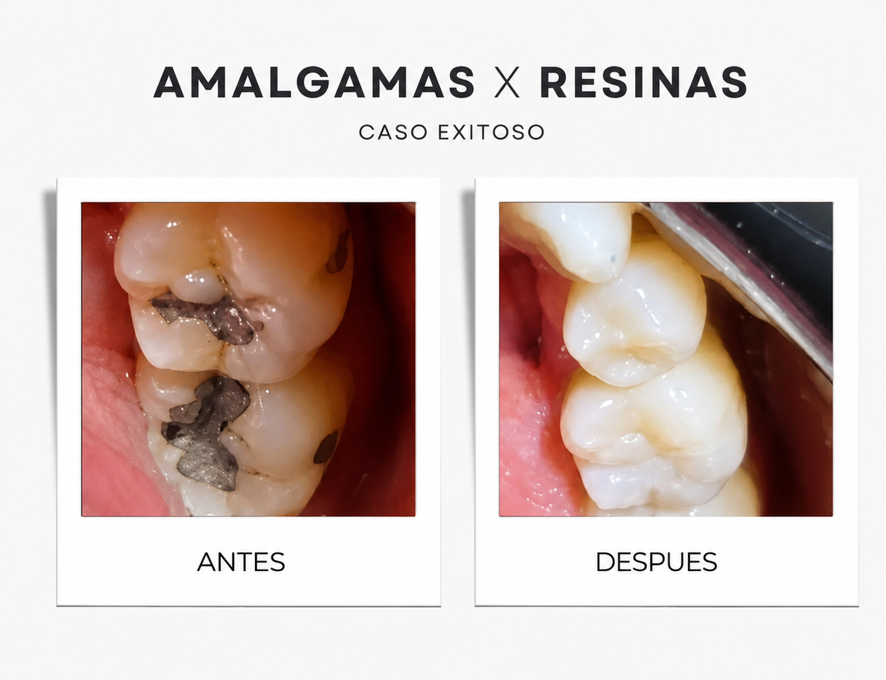 Restauraciones dentales en clínica odontológica de Armenia, Colombia